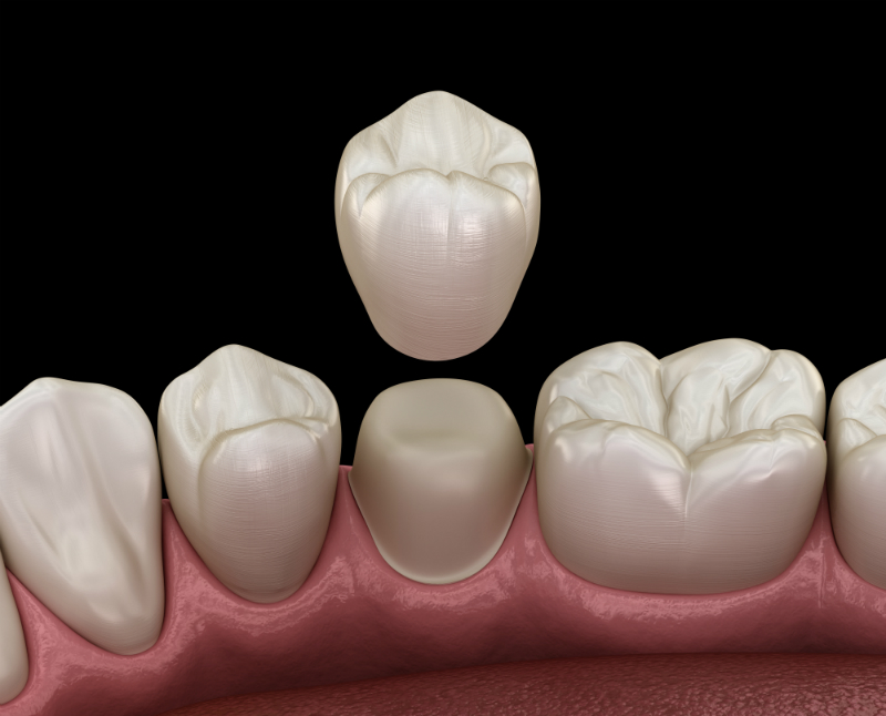 Restoring Your Smile in Philadelphia Doesn’t Have to Stress you Out