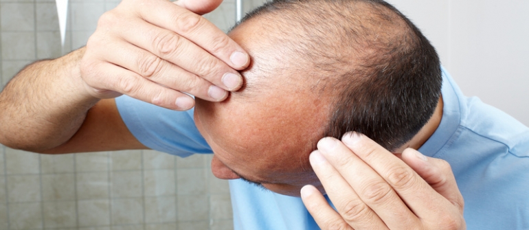 Discover the Causes of Hair Loss and Therapy Options in San Antonio, TX