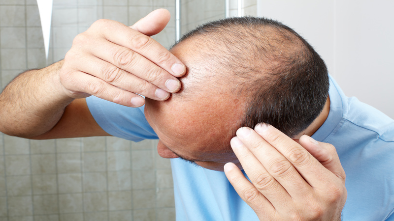 Discover the Causes of Hair Loss and Therapy Options in San Antonio, TX